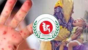 দেশে হাম উপসর্গে আরও ৫ শিশুর মৃত্যু
