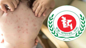 হাম উপসর্গে একদিনে তিনজনের মৃত্যু
